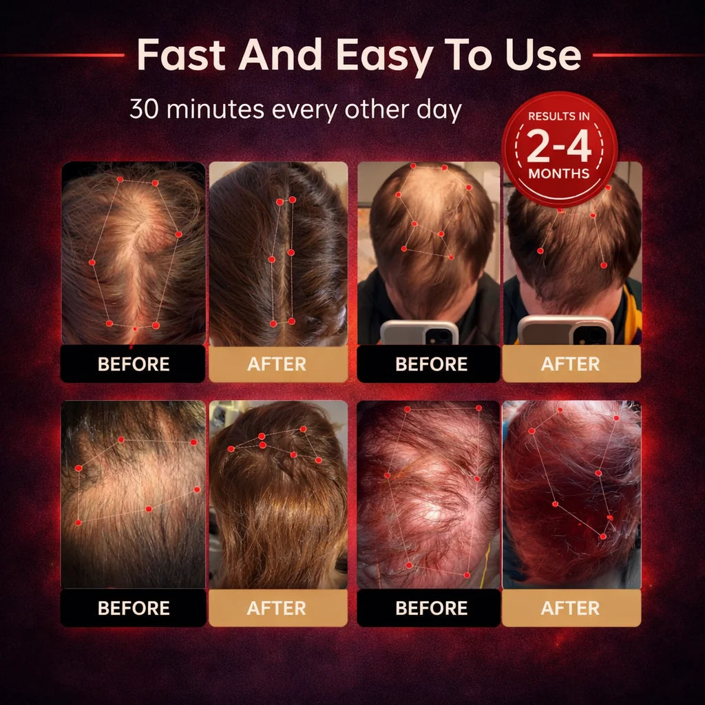 REVYVE™ - Red Light Hair Regrowth Helmet